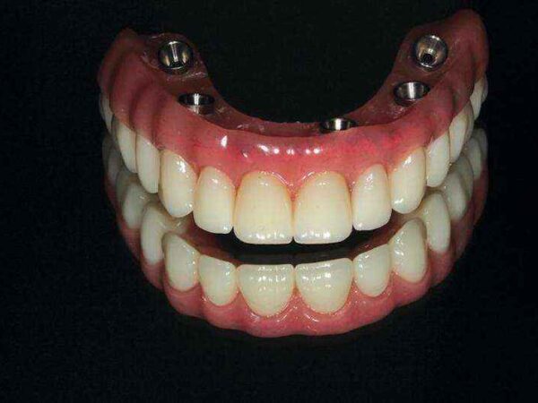 Hibrit Protez CAD/CAM